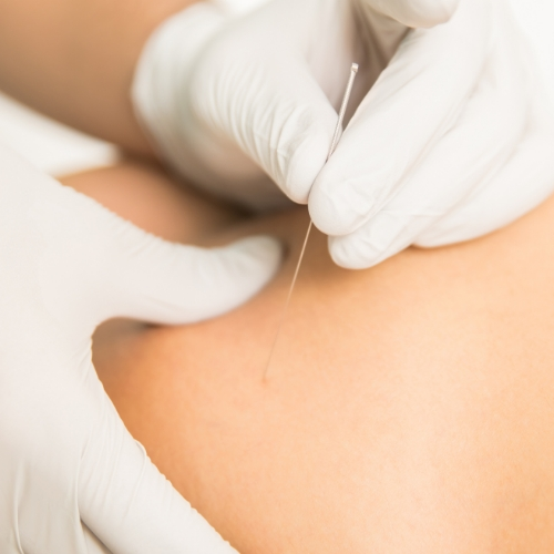 Dry-needling-Loop-PT-Chicago-IL
